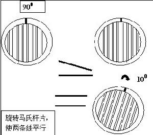 麻痹性斜視