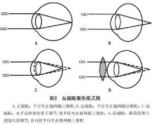 （圖）遠視