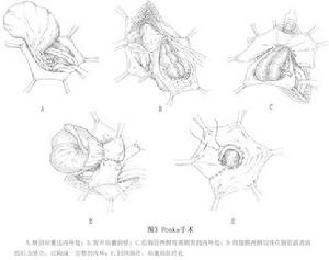 腹股溝滑動疝 圖3