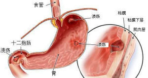 十二指胃潰瘍