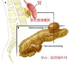 胰腺假囊腫