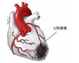 心肌肌鈣蛋白