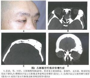 眼眶骨纖維異常增殖症