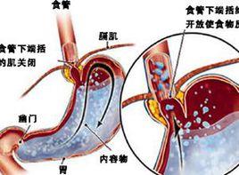 食管下括約肌張力下降