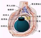 睪丸炸彈