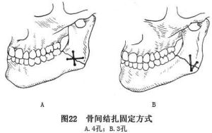 下頜骨表面咬肌剝離術