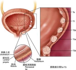 腎盂癌和輸尿管癌