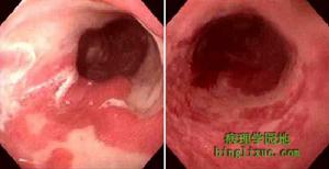 腹膜後纖維化