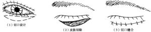 瞼內翻皮膚切除矯正術