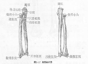 橈骨頸骨折