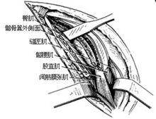 示意圖3:顯露髂骨翼外側面