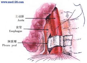 食管穿孔
