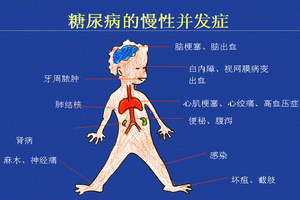 糖尿病腎臟病變