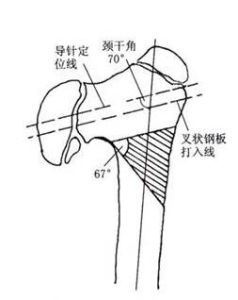 頸乾角