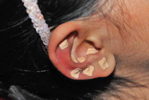 耳穴療法