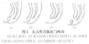 新生兒肛門和直腸畸形