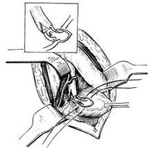 圖5:將兩瓣各縫一針拉入膀胱內(示意圖)