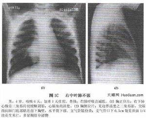 肺不張病