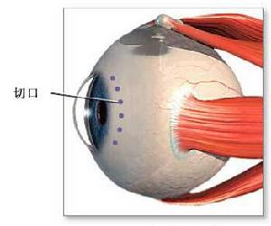 原發性慢性閉角型青光眼