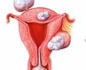 （圖）子宮平滑肌肉瘤