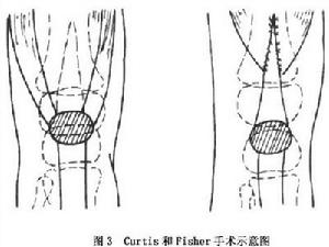 先天性膝關節脫位