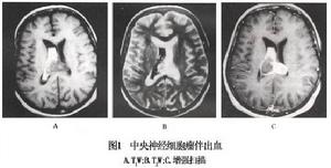 中樞神經細胞瘤