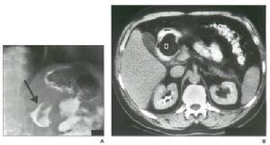 肝硬化性腎損害