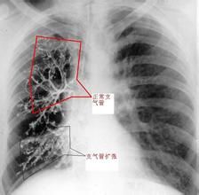 小兒支氣管肺發育不全