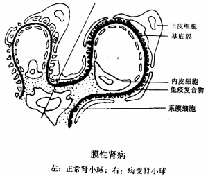 膜性腎病