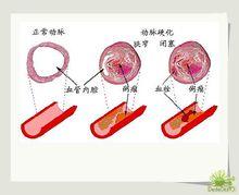 妊娠糖尿病血管硬化症狀