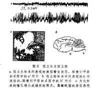 腦幹網狀結構