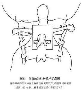 （圖）單純性寰樞椎脫位