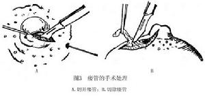 非哺乳期乳暈部瘺管