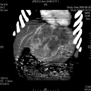 小兒過敏性紫癜性腎炎