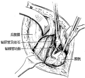 圖4:顯露下段輸尿管(示意圖)