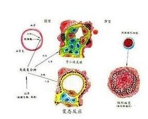 變態反應