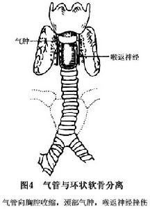 喉部鈍挫傷