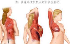 乳腺癌改良根治術