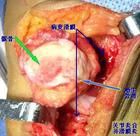 膝關節創傷性滑膜炎