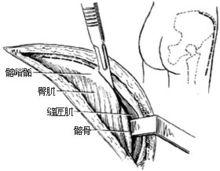 示意圖1:做出手術切口，顯露並切開髂嵴