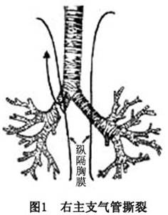 創傷性氣管及主支氣管損傷