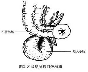 乙狀結腸造口旁溝疝