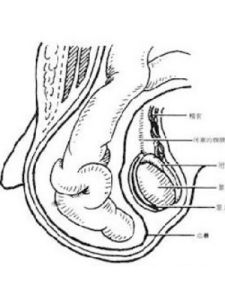 疝氣嵌頓