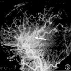 （圖）腦內動脈瘤