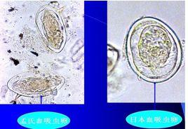 日本分體吸蟲病
