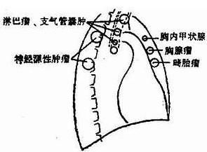 縱隔膿腫