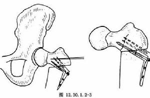 股骨粗隆下截骨術