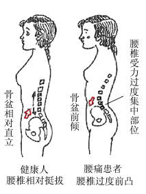 骨盆前傾和正常對比圖。