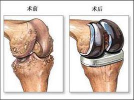 膝外翻的手術