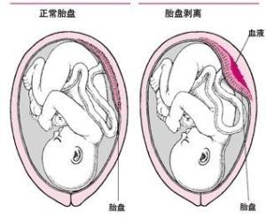 胎盤早期剝離